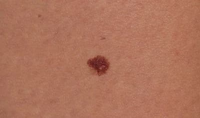 Geen verminderde kwaliteit van leven na pembrolizumab bij melanoom