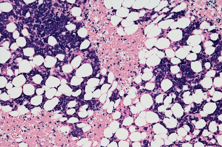 Vroege mortaliteit multipel myeloom laatste 30 jaar afgenomen
