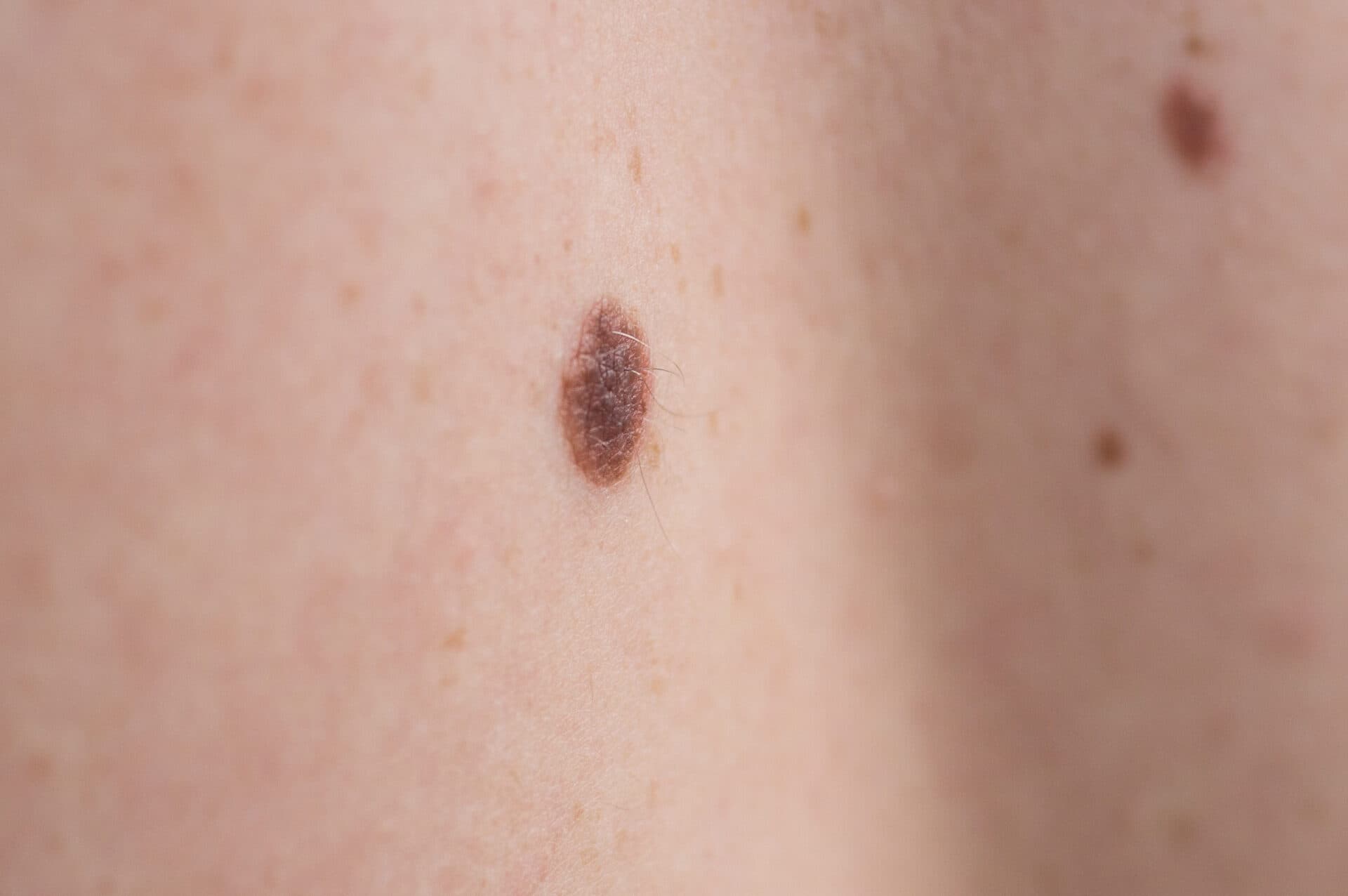 Wat is een melanoom? Symptomen, diagnose en behandeling