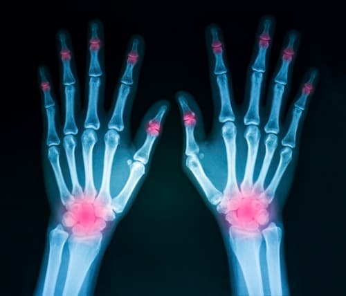 EULAR 2020: Actieve conventionele therapie versus drie biologicals bij vroege RA