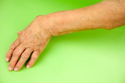 ACR 2020: Hoge ACR-respons met upadacitinib bij actieve PsA