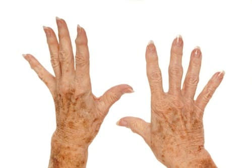 Denervatie mogelijke optie bij osteoartritis van de hand