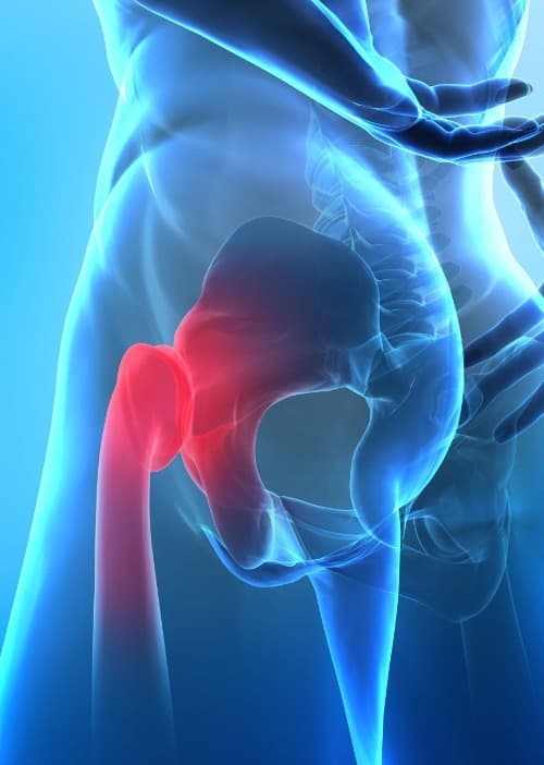 Lage dosis colchicine geassocieerd met minder knie- en heupvervangingen