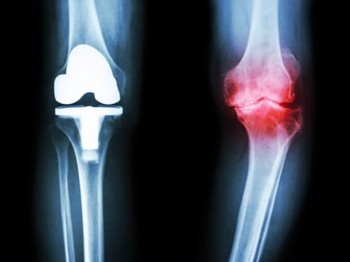 Slechts de helft van RA-patiënten met nieuwe knie loopt na 15 jaar nog buiten