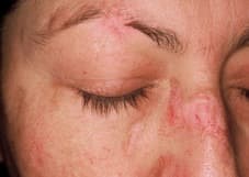 LUPUS & APS 2025: BAFF gelinkt aan longschade bij SLE-patiënten