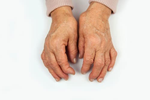Methotrexaat effectief tegen handartrose met synovitis