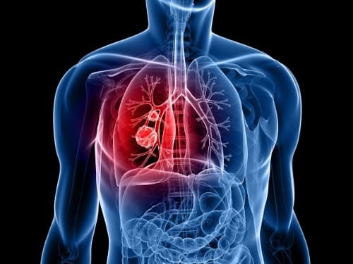 Tumorvolume betere prognostische factor dan diameter bij operabel NSCLC