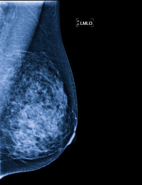 CanAssist Breast voorspelt risico op recidief bij HR+/HER2-borstkanker