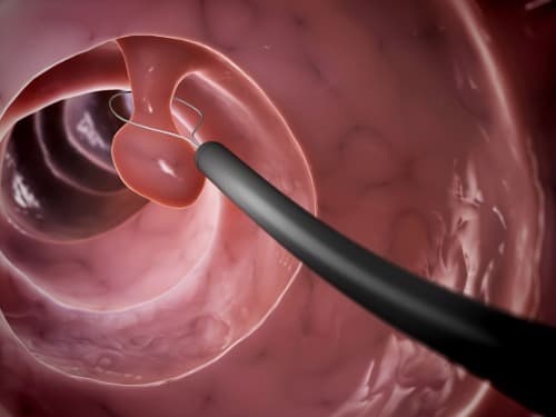 Centralisatie complex oncologische zorg voor darmkanker succesvol