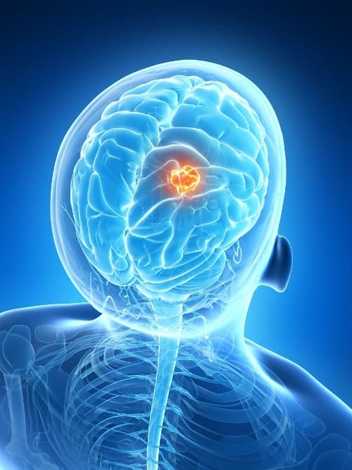 Gelijktijdige chemo- en radiotherapie niet effectief bij glioom