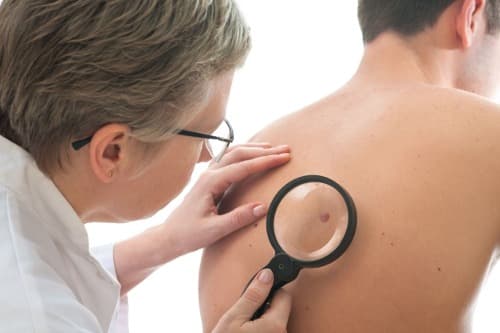 Chronisch gebruik van hydrochloorthiazide verhoogt risico op huidkanker