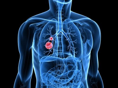 Piekdosis corticosteroïden gekoppeld aan slechtere overleving NSCLC