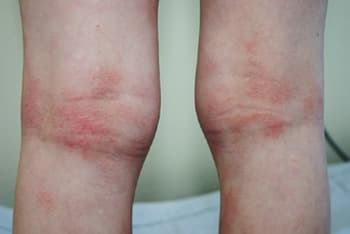 Dupilumab behoudt effecten lange termijn bij AD