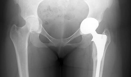 Toegenomen VTE-risico bij artrose van knie en heup, maar niet van hand