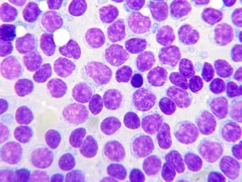 Acalabrutinib niet inferieur aan ibrutinib, wel minder bijwerkingen
