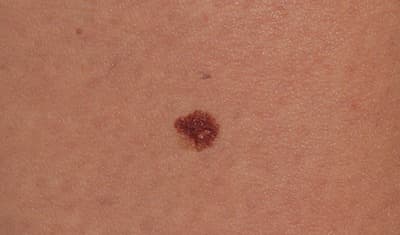 Respons op neoadjuvante therapie voorspelt overleving bij melanoom
