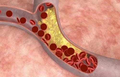 Causaal verband tussen reumatische aandoeningen en cholesterolwaarden