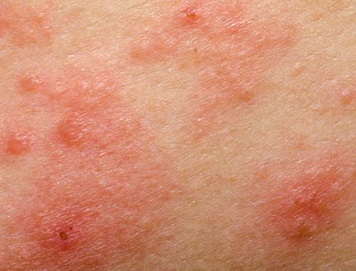 Wereldwijd consensus over methotrexaat bij atopische dermatitis