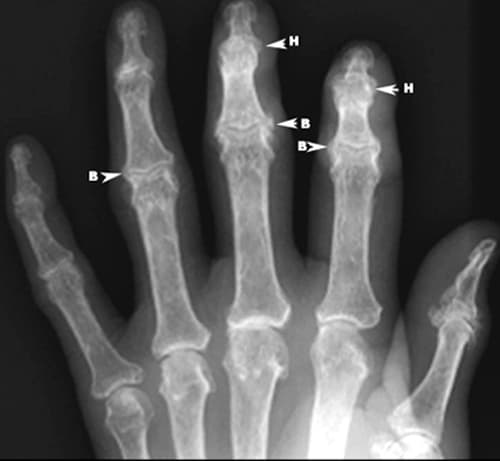 Geen associatie tussen biomarkers en respons op prednisolon bij hand-OA