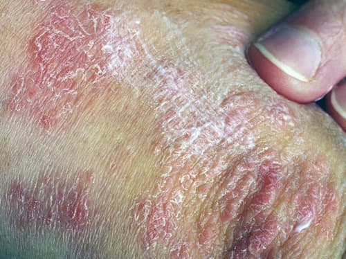 Nog geen goede biomarker voor ontwikkeling PsA bij psoriasis