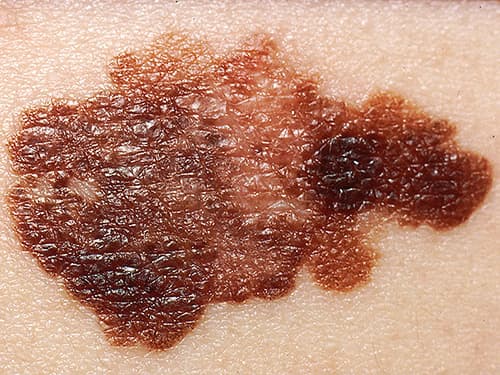 Complexe relatie microbioom en remmers immunologische checkpoints