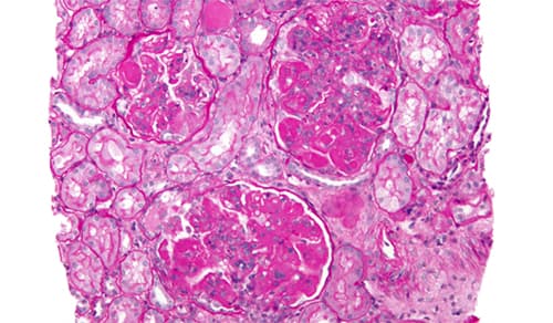 Combinatietherapieën verbeteren nierrespons bij lupus nefritis