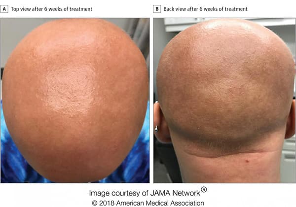 Eczema drug restores hair growth in patient with longstanding alopecia