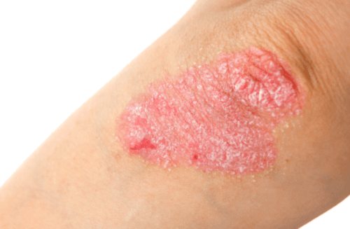 Betere kwaliteit van leven bij behandeling psoriasis met apremilast