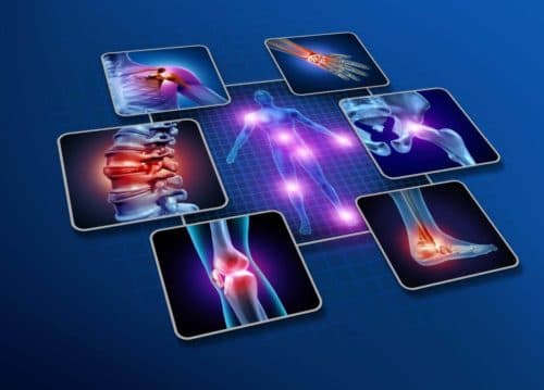 Daling fibromyalgie - diagnoses door strengere criteria – risico op onderdiagnose