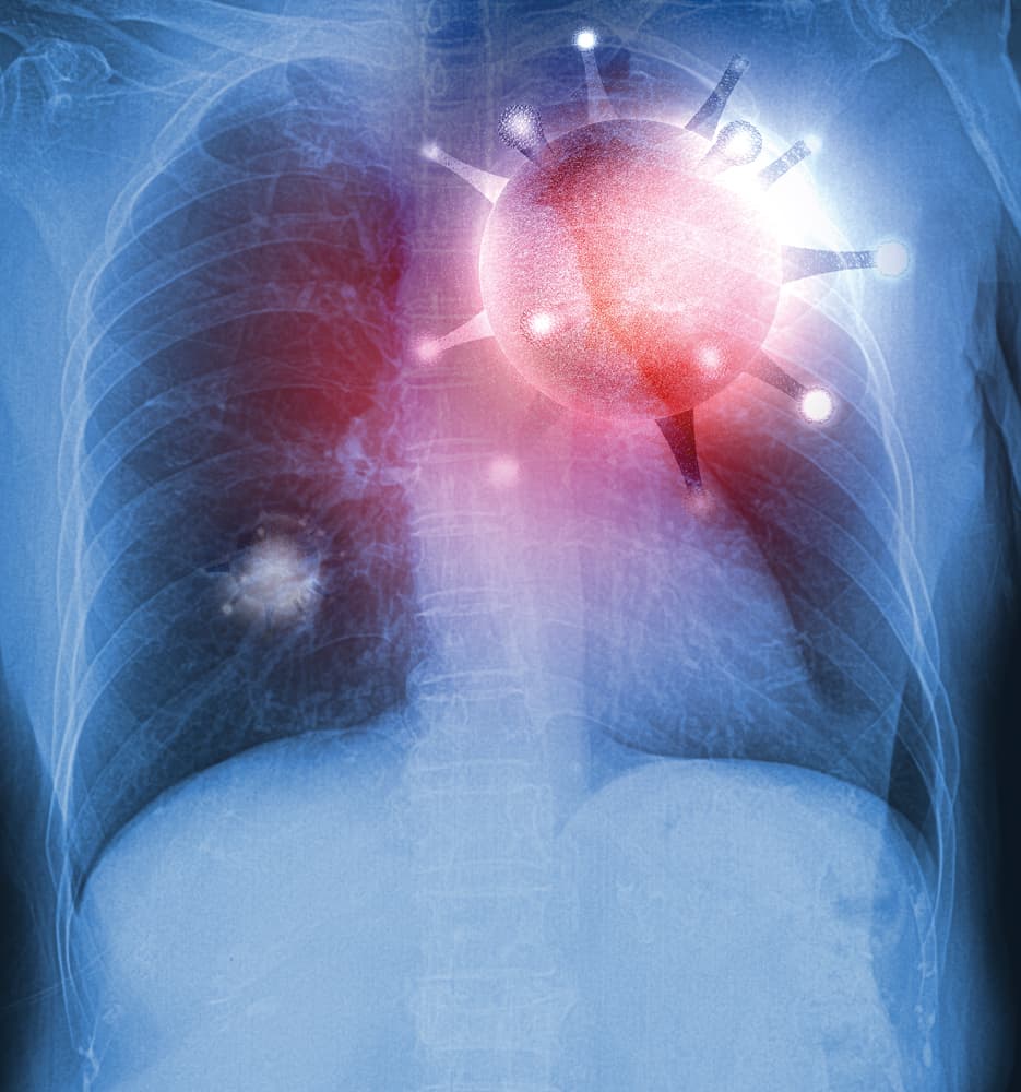 Radiologische beeld van COVID-19