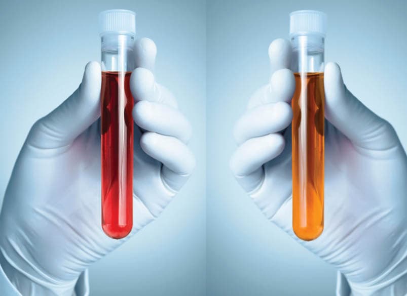 Real world-analyse van biosimilars bij reumatische ziektes