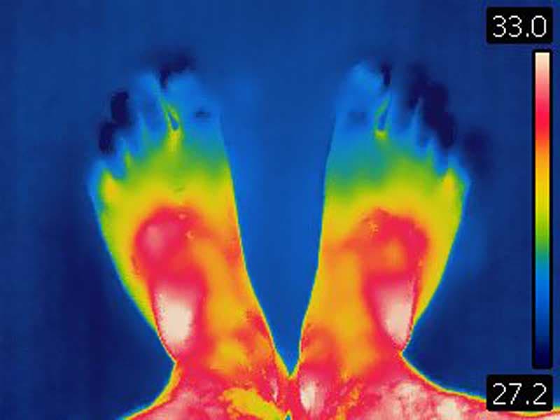 Warmtepatronen voeten RA-patiënten verschillen van gezonde controles