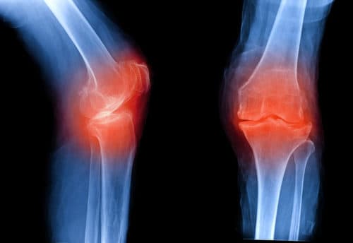 Verhoogd fractuurrisico bij gelijktijdig gebruik van glucocorticoïden en PPI’s