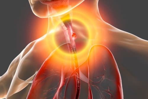 Uitkomsten definitieve chemoradiotherapie bij slokdarmkanker variëren
