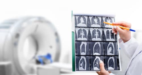 Liever geen ultra low-dose CT in plaats van X-thorax op de SEH