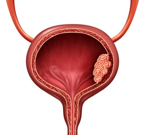 Weefselbiomarkers bij urotheelcarcinoom: klinische relevantie en richtlijnen
