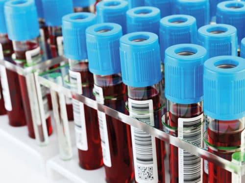 Kleine deeltjes circulerende tumorcellen voorspellen prognose NSCLC