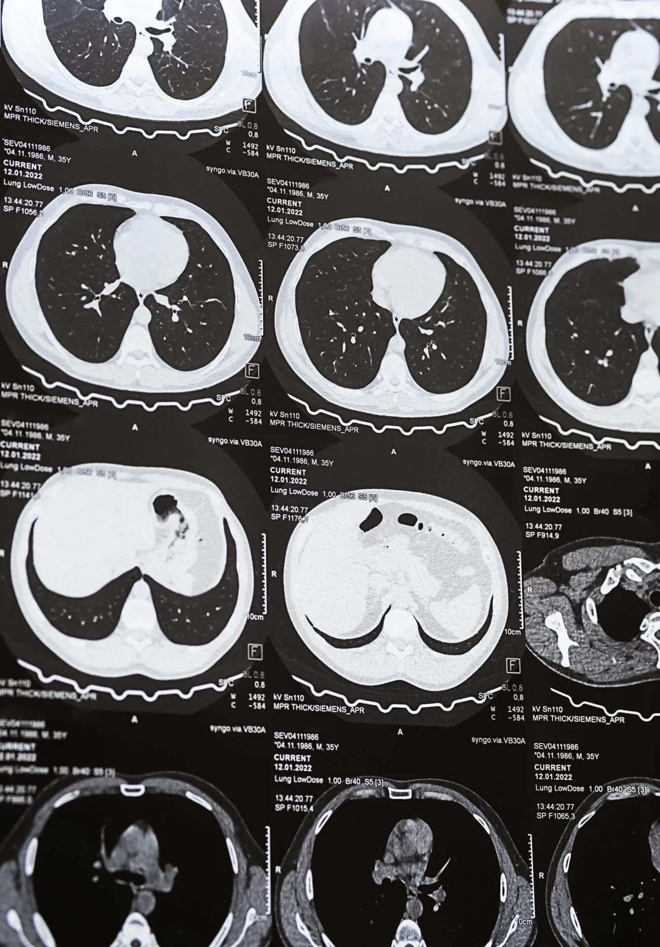 Bronchiëctasieën: brensocatib als eerste geregistreerde behandeling