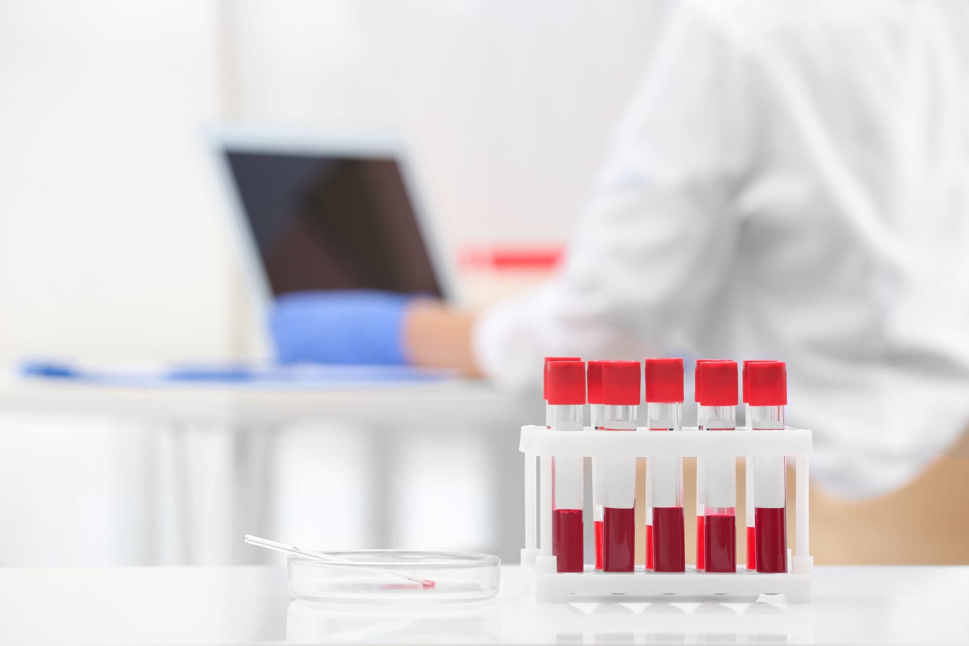 Prolactine hoog, androgenen laag bij SLE (lupus)