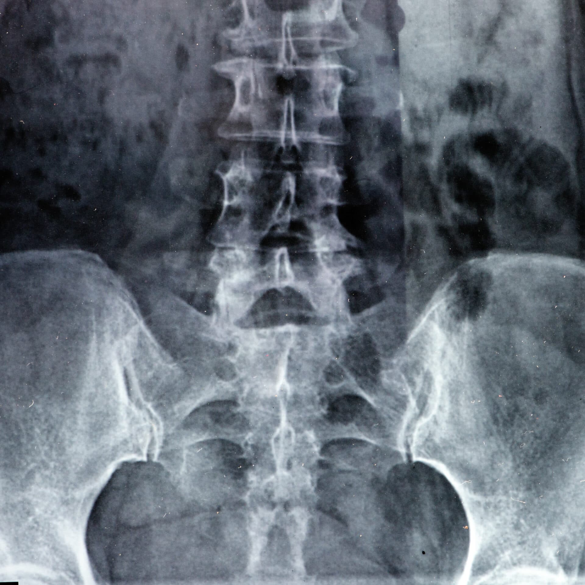 Axiale spondyloartritis: behandeling volgens de ASAS-EULAR-aanbevelingen