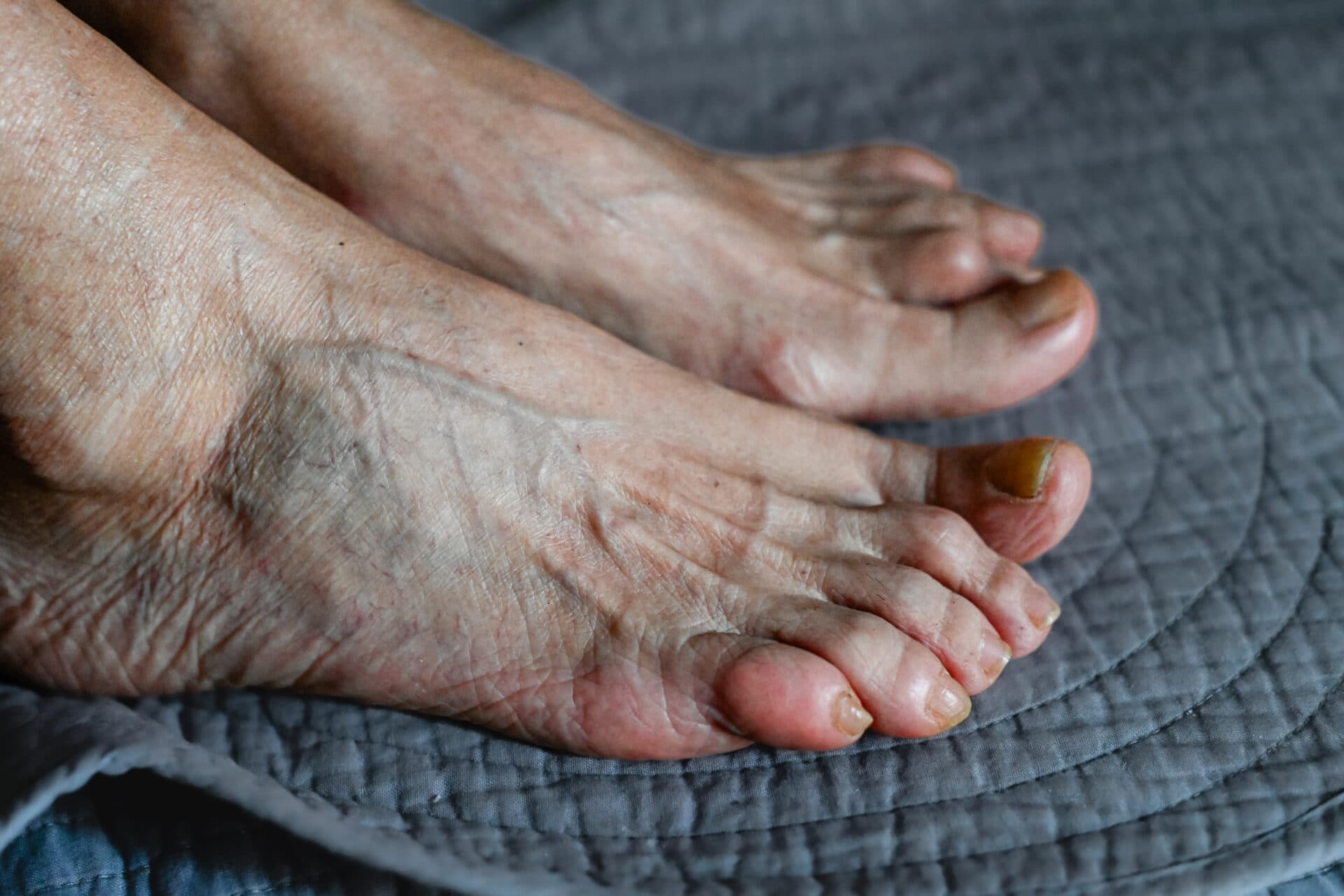 Wat is jicht? Symptomen, oorzaken en behandeling
