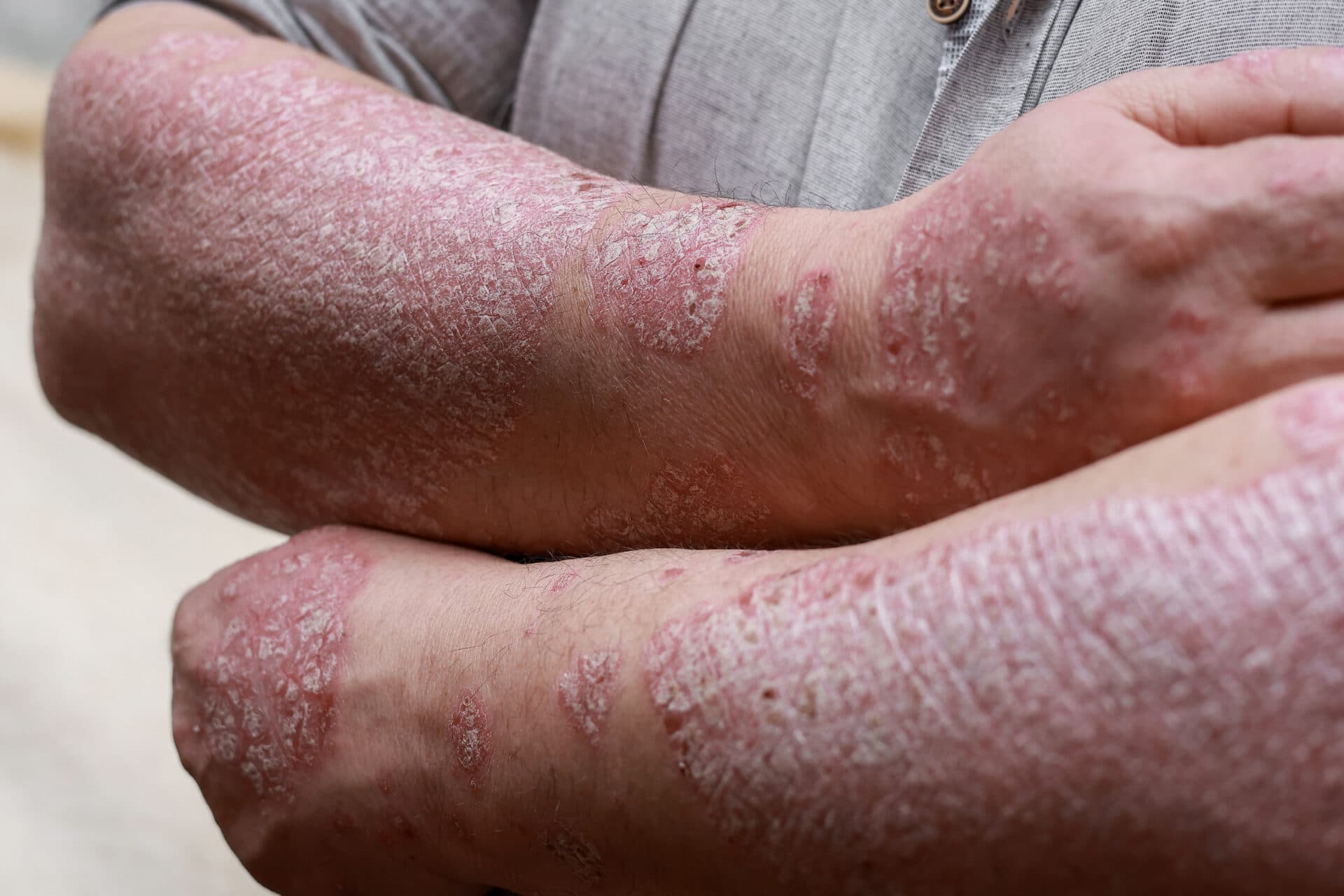 Wat is psoriasis? Symptomen, oorzaken en behandeling